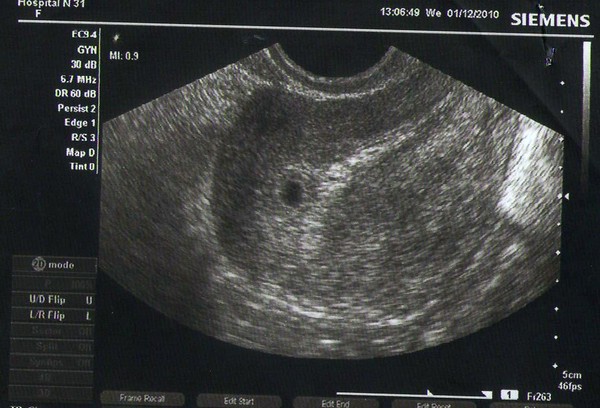 Узи 3 4 недели. УЗИ на сроке 4 недели беременности. Снимок УЗИ беременность малого срока 3 недели. Маточная беременность 4 недели на УЗИ. УЗИ при беременности на ранних сроках 4 недели.