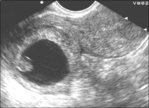 Оплодотворение в полости матки. Внематочная беременность в рудиментарном Роге на УЗИ. Внематочная Трубная беременность УЗИ. Внематочная беременность в рудиментарном Роге. Беременность УЗИ на внематочную беременность.